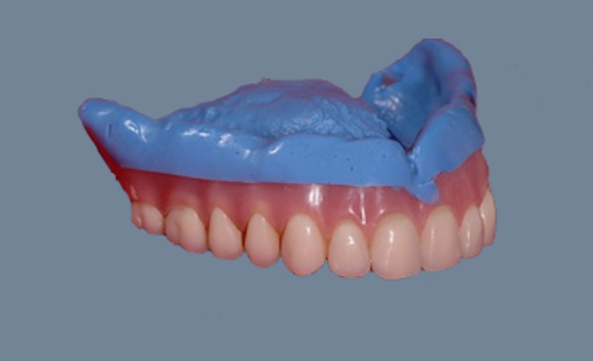 relined denture example